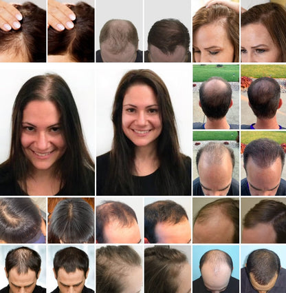 OFERTA 2 X 1 || ¡Haga crecer su cabello nuevamente en 120 días con STEM Cell Complete Hair! - Ampolleta Anticaída y Crecimiento